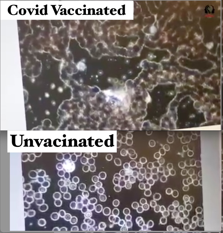 Microscope Analysis shows major clogging of Blood Cells in Vaccinated compared to&nbsp;Unvaccinated
